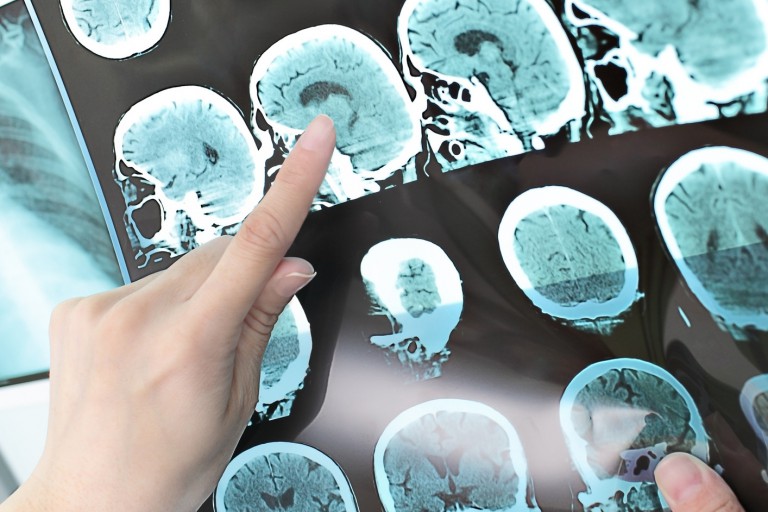Person pointing at an x-ray of a brain.